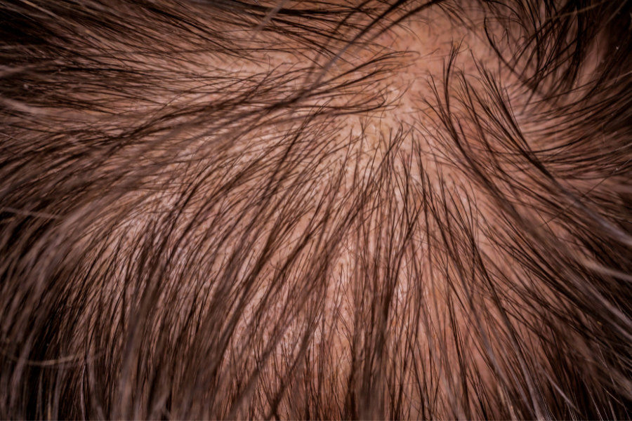 Hereditary Baldness - Alopecia Androgenetica