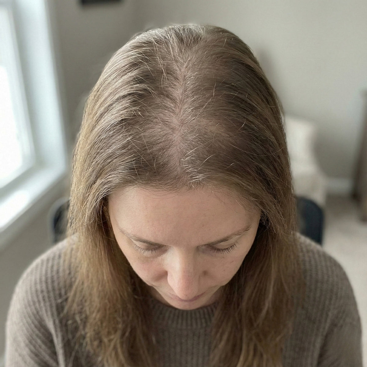 Alopecia diffusa nelle donne